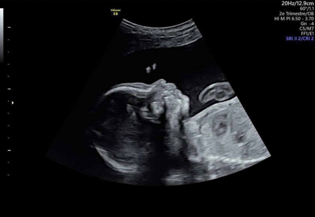 Image échographique classique en noir et blanc d'un bébé de profil, montrant la tête, le corps et les bras enroulés.