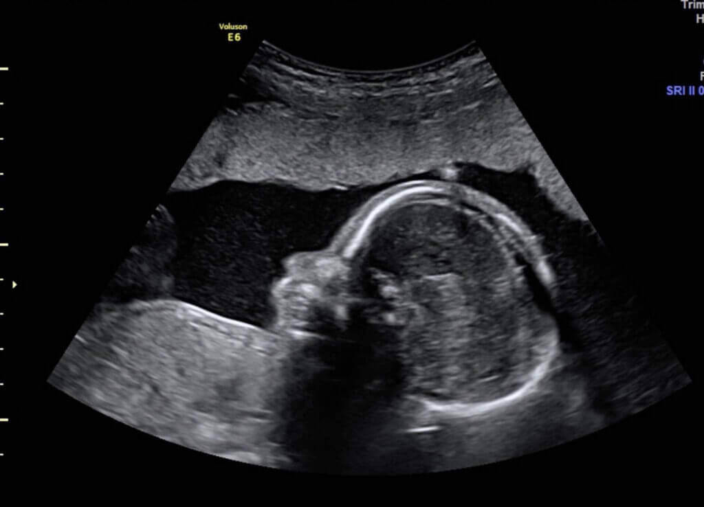 nouveau-né emmailloté dans une couverture d'hôpital blanche, dont les traits délicats du visage sont visibles